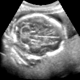 Hughes shadow-reduced fetal brain ultrasound image