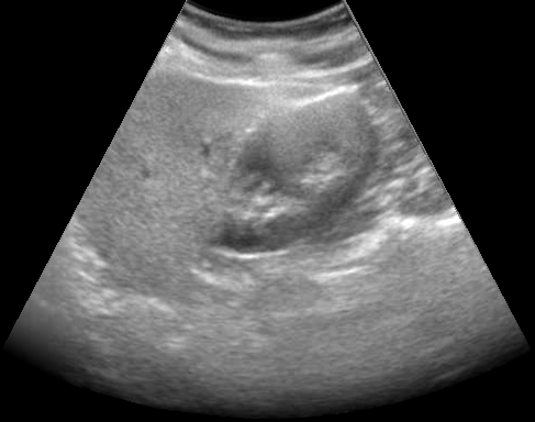 Hughes shadow-reduced abdominal ultrasound image
