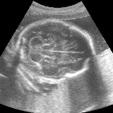 Original fetal brain ultrasound image