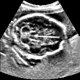 RFlash shadow-reduced fetal brain ultrasound image