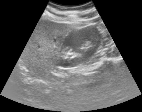 RFlash shadow-reduced abdominal ultrasound image